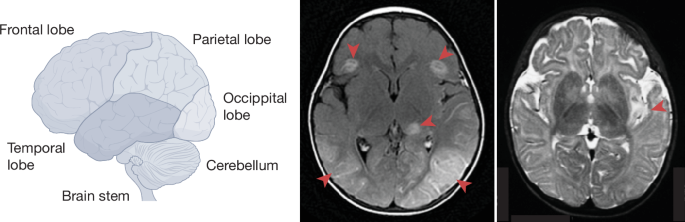 Genetic defects of brain immunity in childhood herpes simplex encephalitis