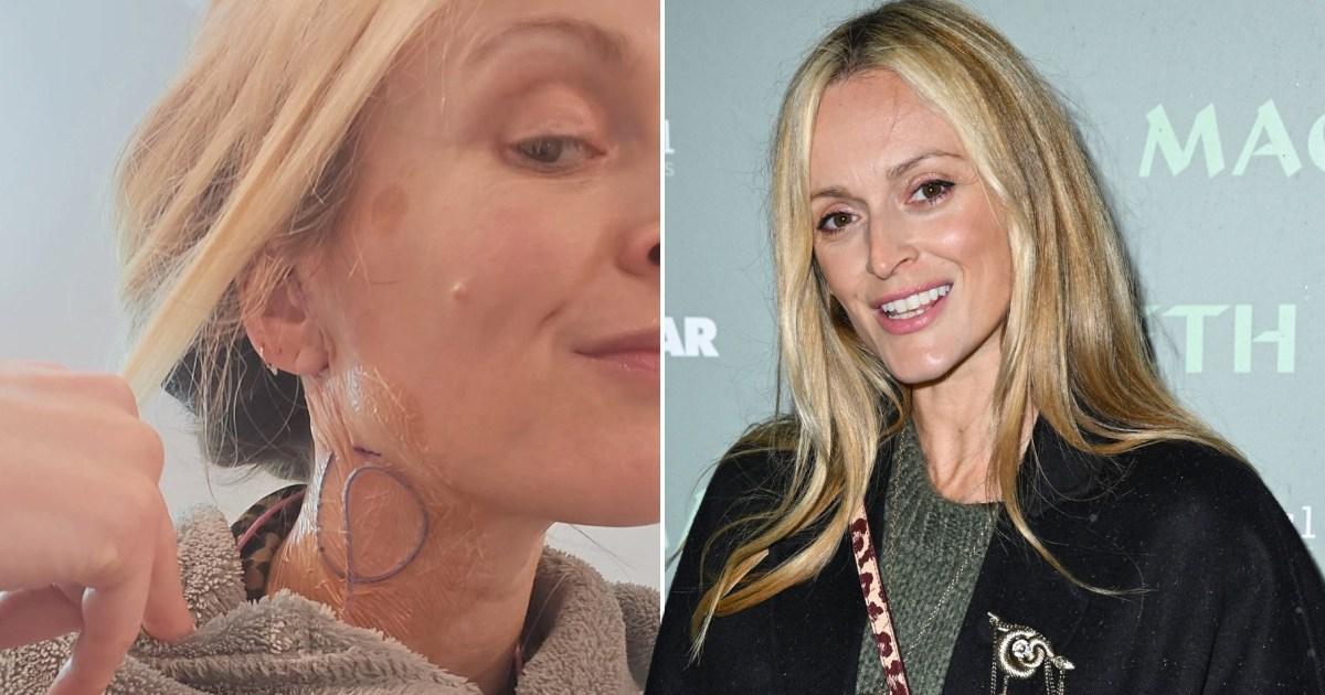 Fearne Cotton reveals tumour scars she’ll ‘wear with pride’ after surgery