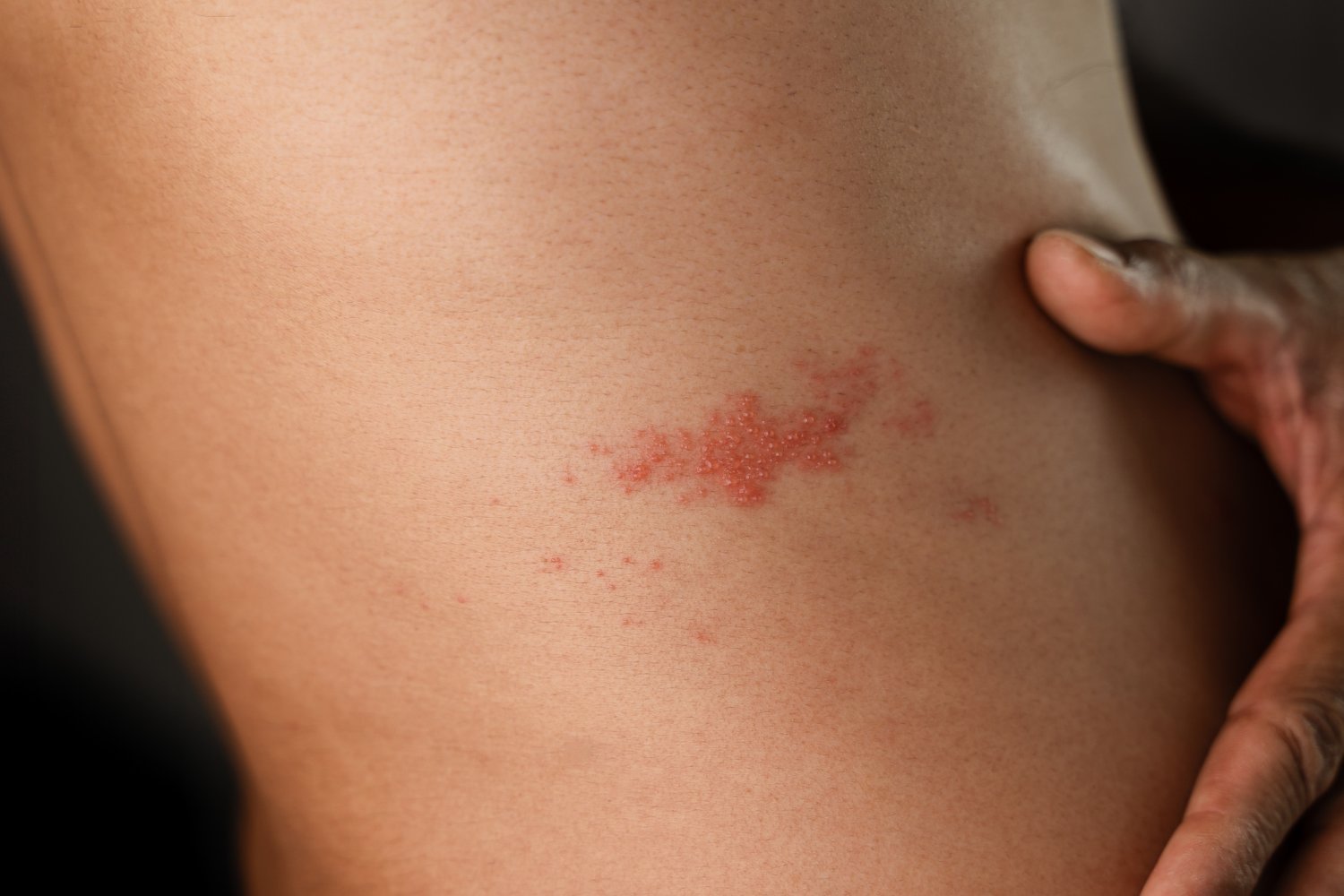 The Shingles Vaccine Could Be a Secret Weapon Against Heart Attacks