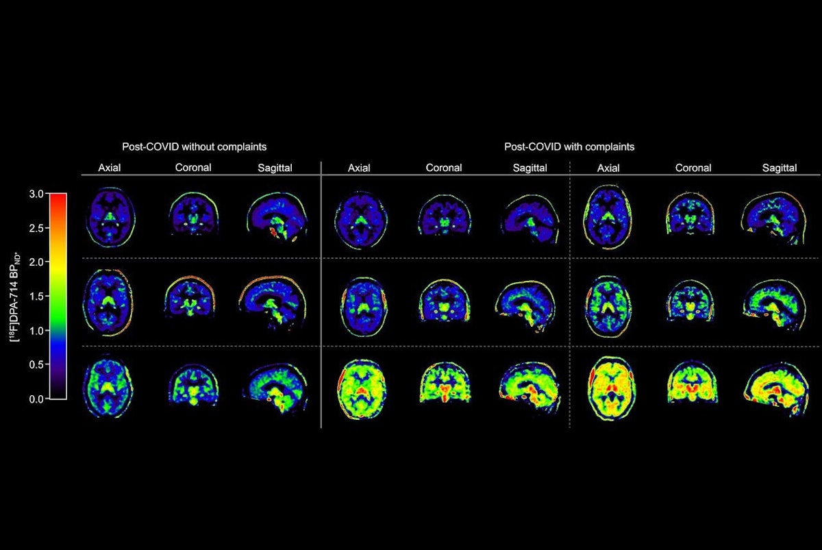 Neuroinflammation persists for 2 years in long COVID