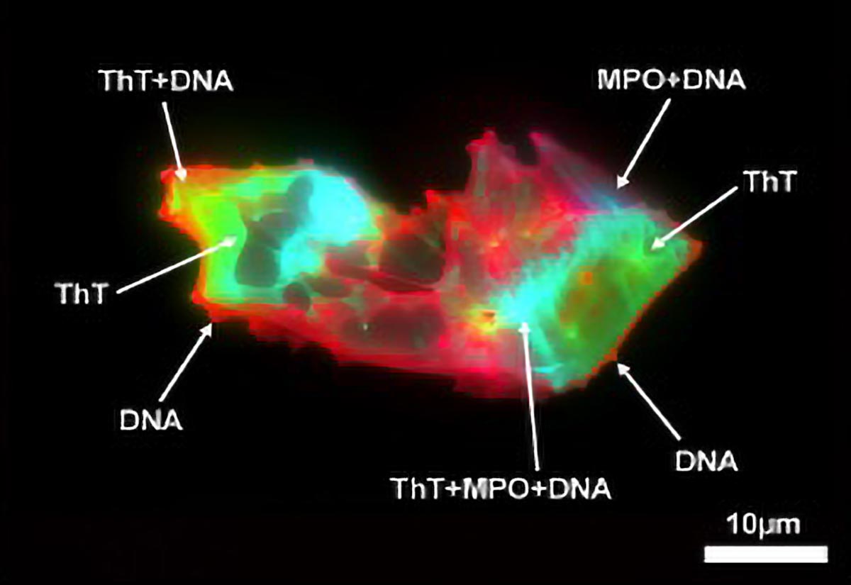 Scientists Uncover Hidden Blood Pattern in Long COVID