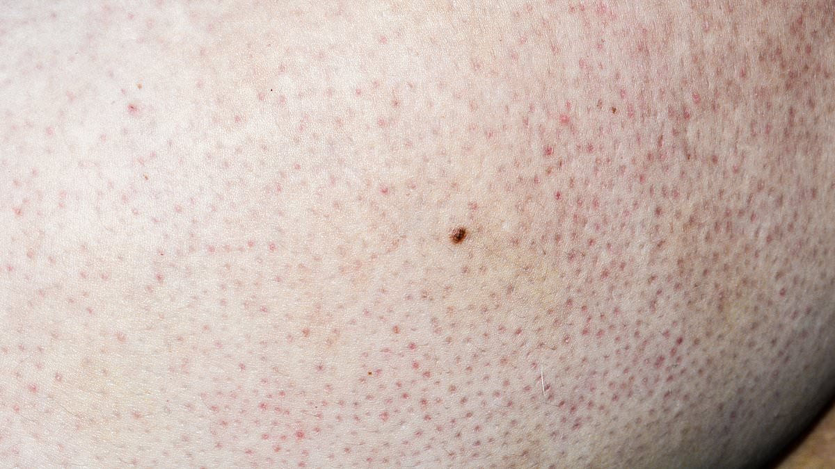 I've discovered red spots on my arms and I've no idea where they've come from - should I be worried? DR PHILIPPA KAYE reveals the unsightly and uncurable skin condition to blame... and why it's on the rise