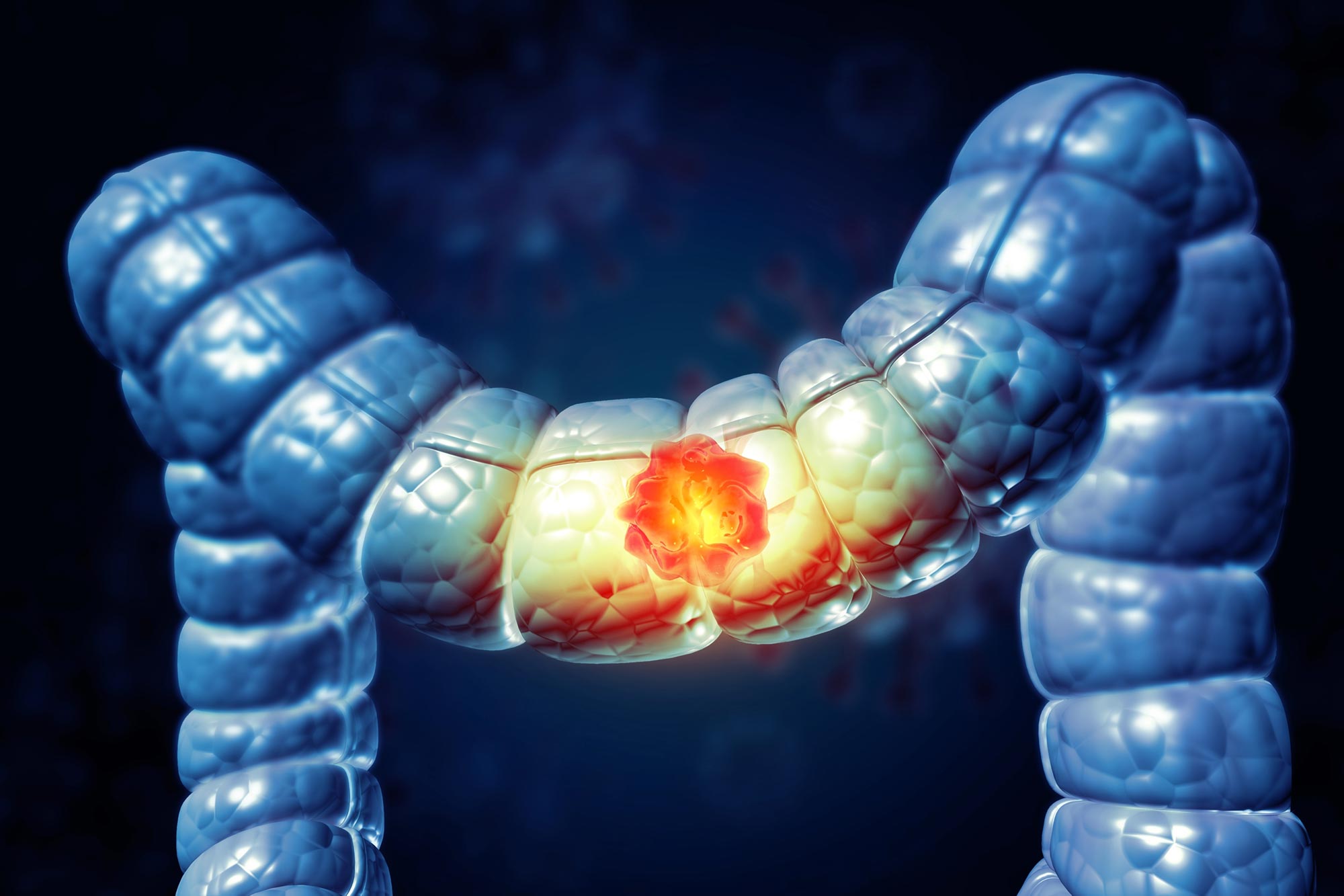 Why Colon Cancer Is Rising in Young Adults: Scientists Discover Unexpected Physical Clue