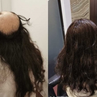 Hair Replacement SG