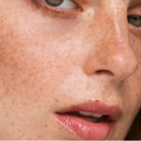 pigmentation removal singapore