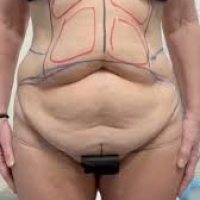 Breast Reduction Surgery Long Island